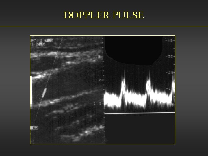 DOPPLER PULSE 