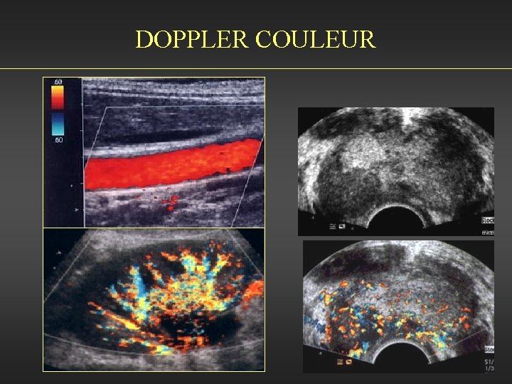 DOPPLER COULEUR 