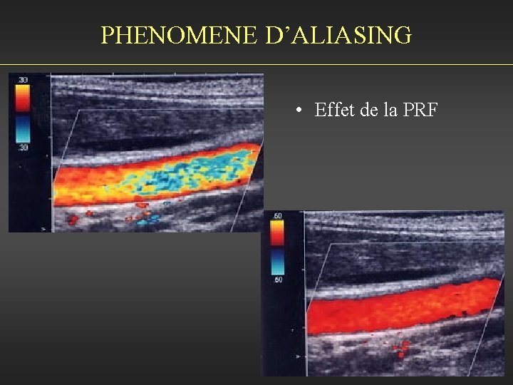 PHENOMENE D’ALIASING • Effet de la PRF 