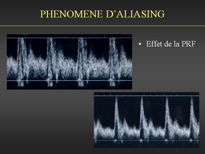 PHENOMENE D’ALIASING • Effet de la PRF 