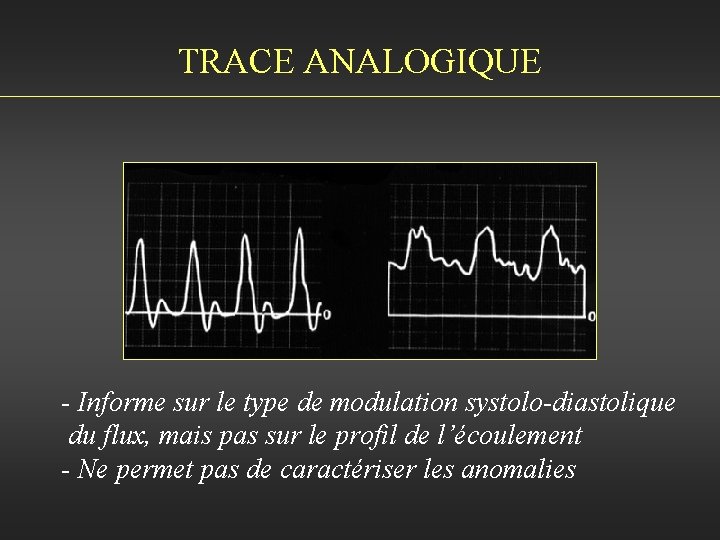 TRACE ANALOGIQUE - Informe sur le type de modulation systolo-diastolique du flux, mais pas