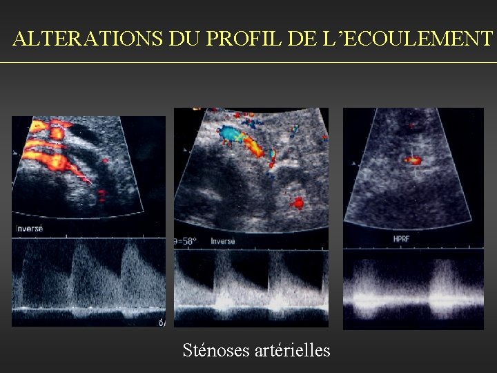 ALTERATIONS DU PROFIL DE L’ECOULEMENT Sténoses artérielles 