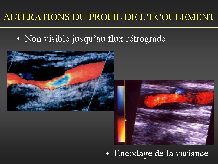 ALTERATIONS DU PROFIL DE L’ECOULEMENT • Non visible jusqu’au flux rétrograde • Encodage de