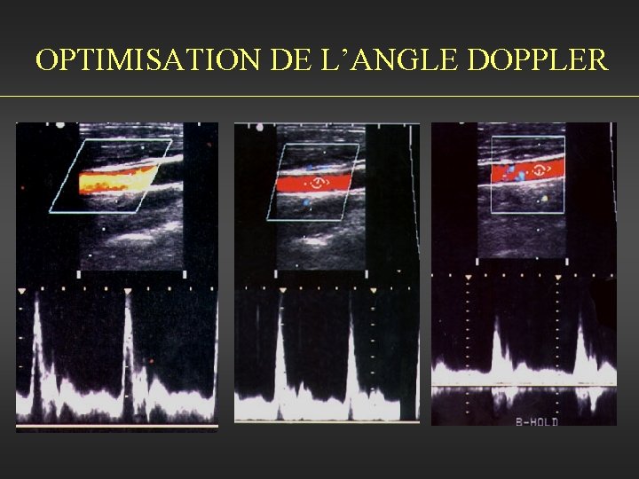 OPTIMISATION DE L’ANGLE DOPPLER 