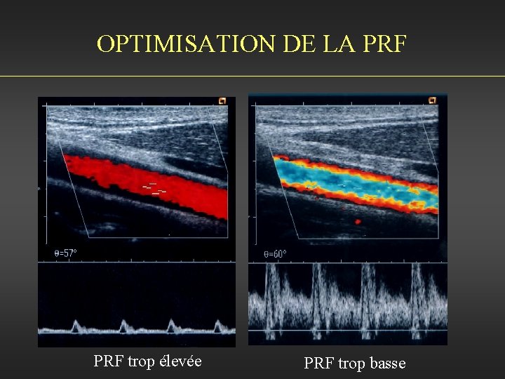 OPTIMISATION DE LA PRF trop élevée PRF trop basse 