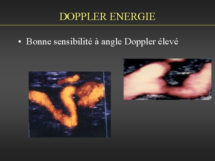 DOPPLER ENERGIE • Bonne sensibilité à angle Doppler élevé 