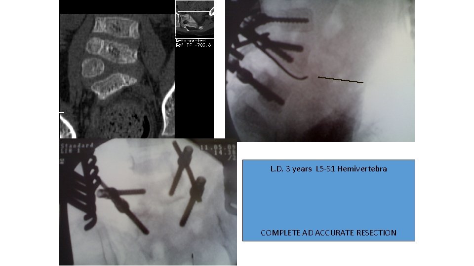 L. D. 3 years L 5 -S 1 Hemivertebra COMPLETE AD ACCURATE RESECTION 