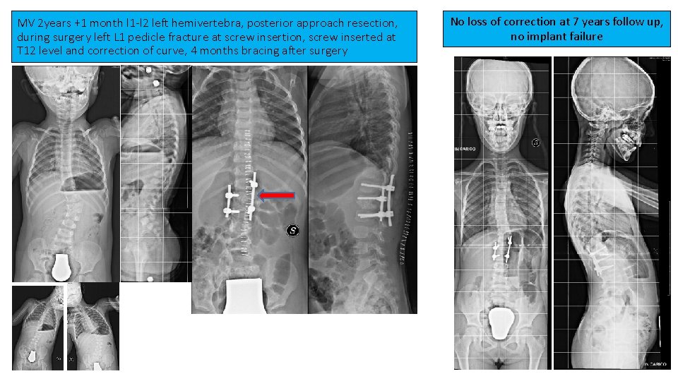 MV 2 years +1 month l 1 -l 2 left hemivertebra, posterior approach resection,
