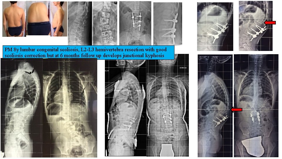 PM 8 y lumbar congenital scoliosis, L 2 -L 3 hemivertebra resection with good