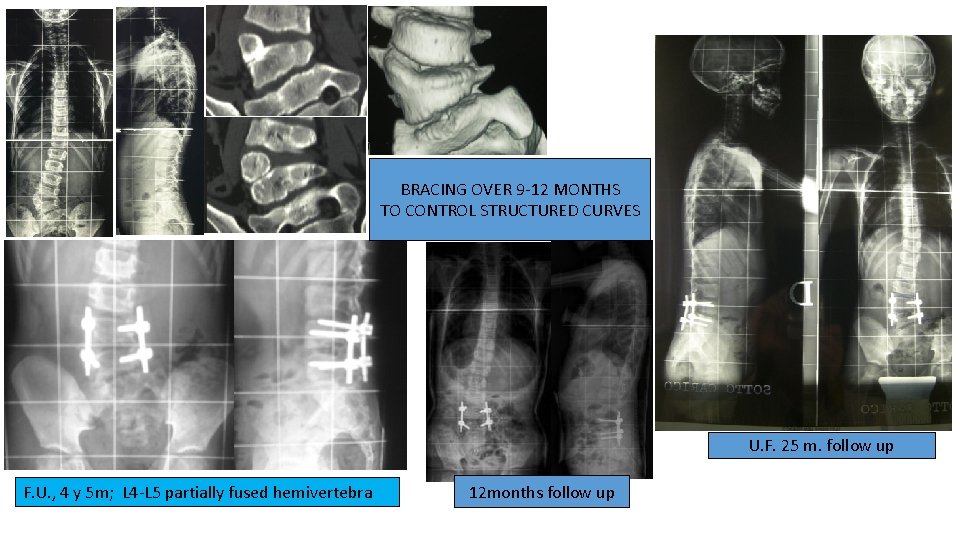 BRACING OVER 9 -12 MONTHS TO CONTROL STRUCTURED CURVES U. F. 25 m. follow