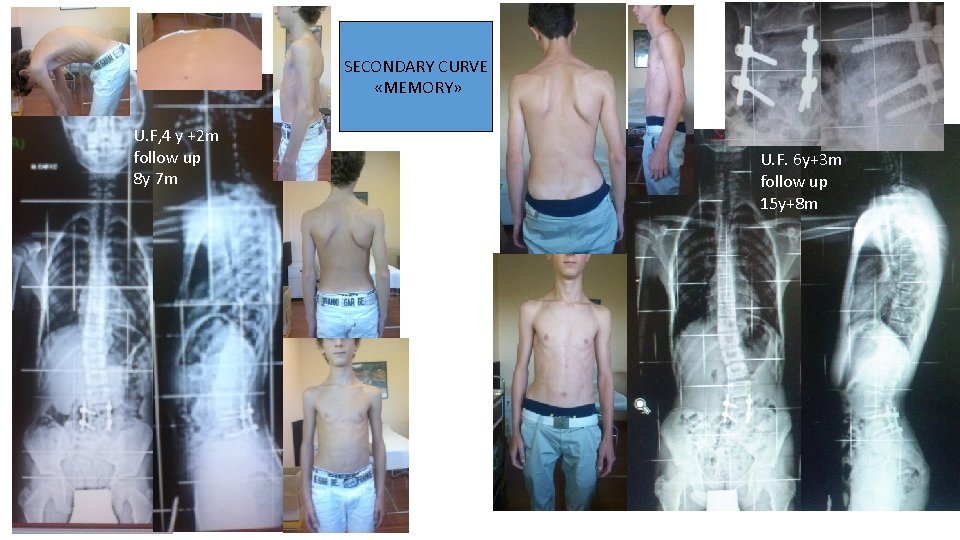 SECONDARY CURVE «MEMORY» U. F, 4 y +2 m follow up 8 y 7