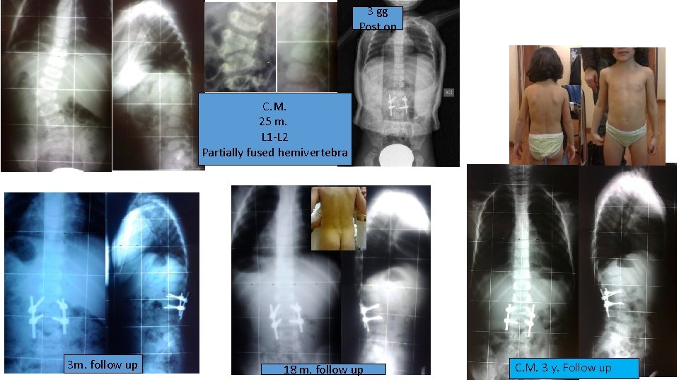 3 gg Post op C. M. 25 m. L 1 -L 2 Partially fused