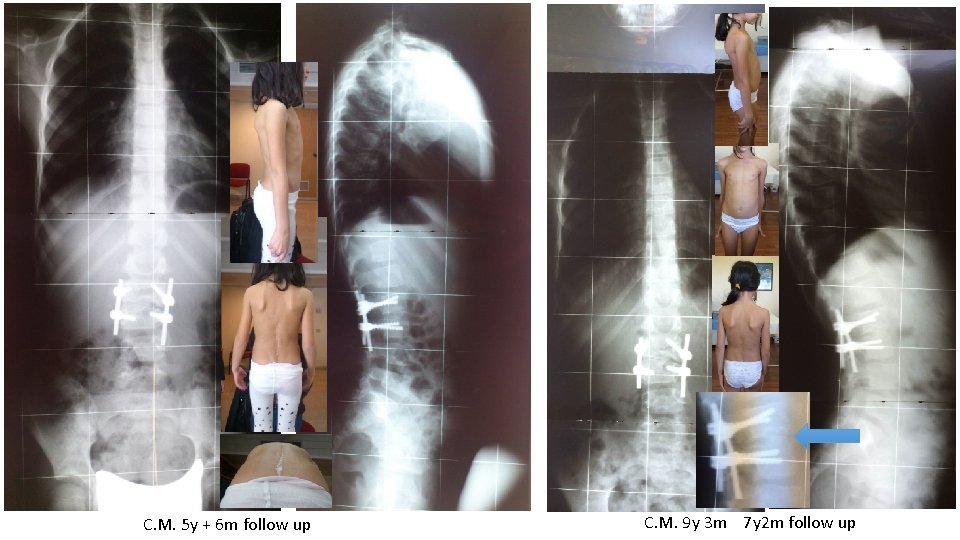 C. M. 5 y + 6 m follow up C. M. 9 y 3