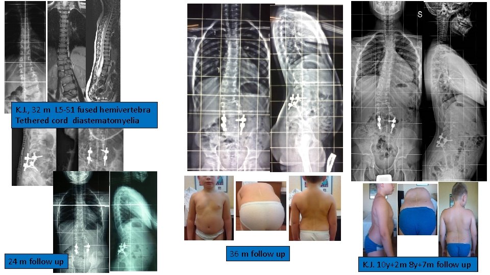 K. J. , 32 m L 5 -S 1 fused hemivertebra Tethered cord diastematomyelia