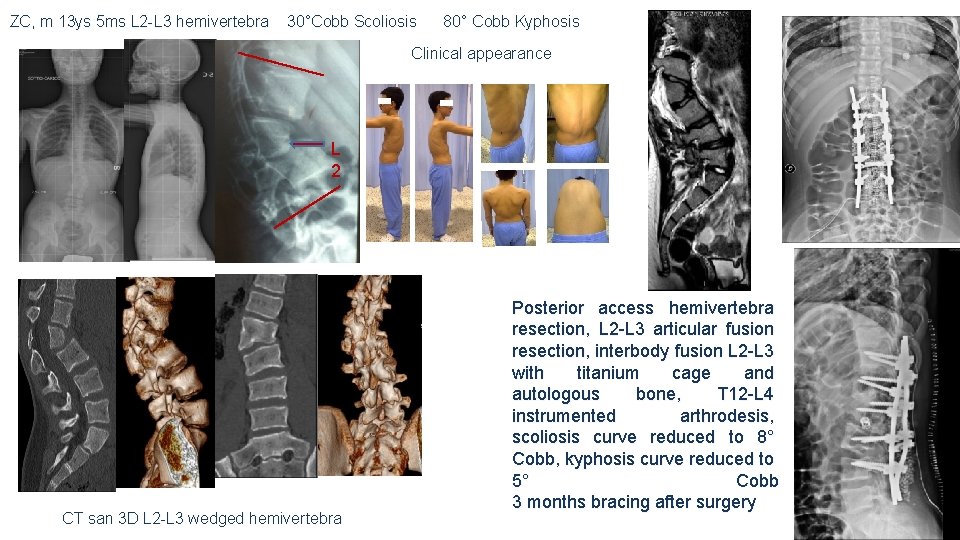 ZC, m 13 ys 5 ms L 2 -L 3 hemivertebra 30°Cobb Scoliosis 80°