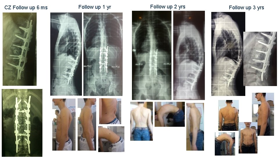 CZ Follow up 6 ms Follow up 1 yr Follow up 2 yrs Follow