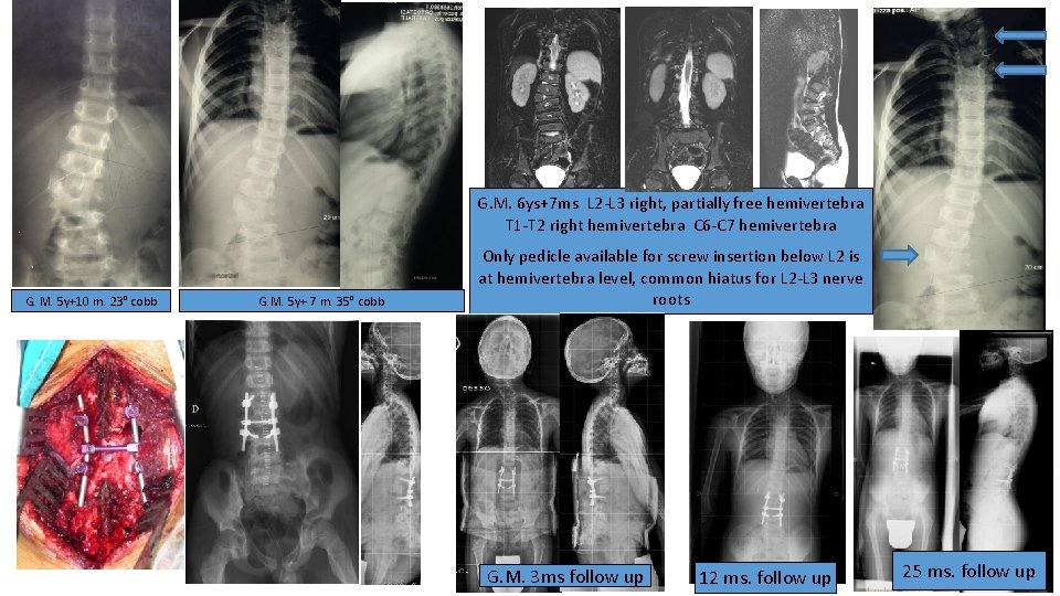 G. M. 6 ys+7 ms L 2 -L 3 right, partially free hemivertebra T