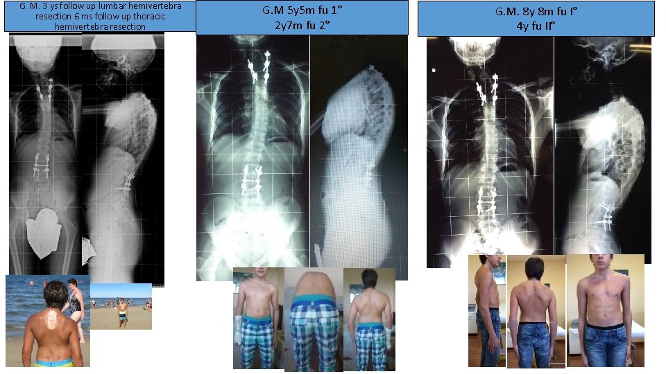 G. M. 3 ys follow up lumbar hemivertebra resection 6 ms follow up thoracic