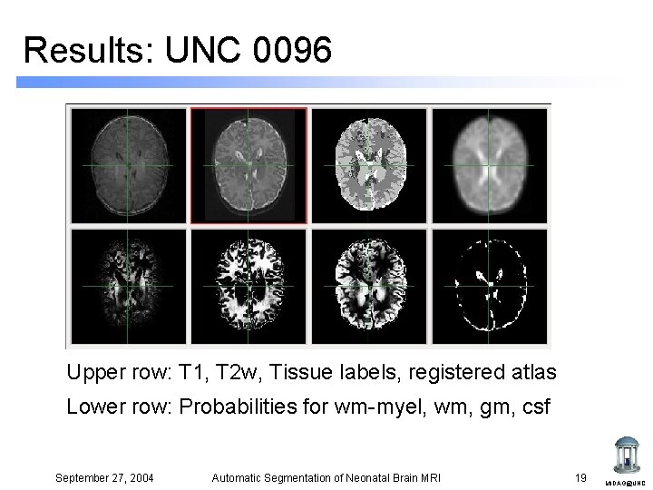Results: UNC 0096 Upper row: T 1, T 2 w, Tissue labels, registered atlas Results: UNC 0096 Upper row: T 1, T 2 w, Tissue labels, registered atlas