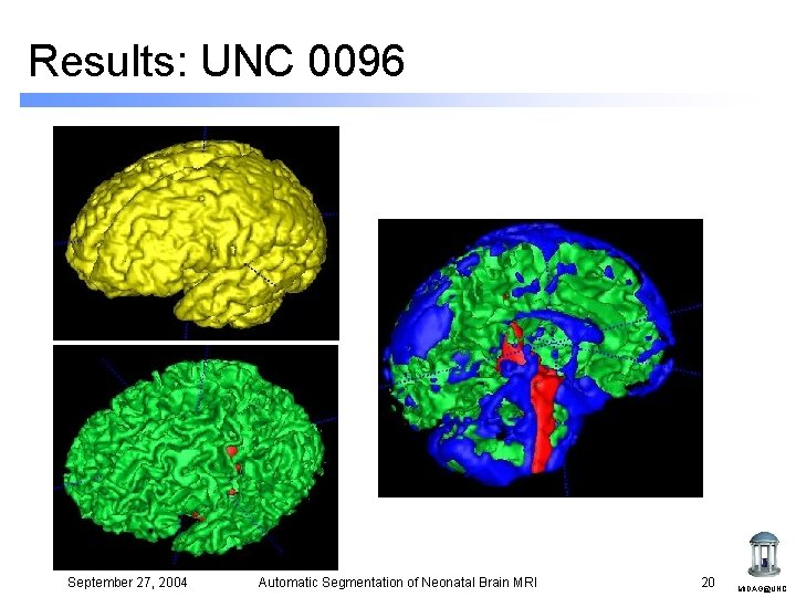 Results: UNC 0096 September 27, 2004 Automatic Segmentation of Neonatal Brain MRI 20 MIDAG@UNC Results: UNC 0096 September 27, 2004 Automatic Segmentation of Neonatal Brain MRI 20 MIDAG@UNC
