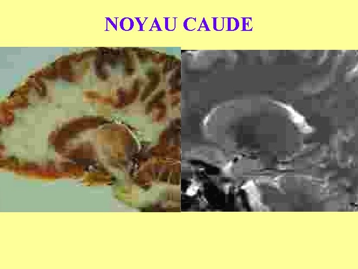 NOYAU CAUDE 