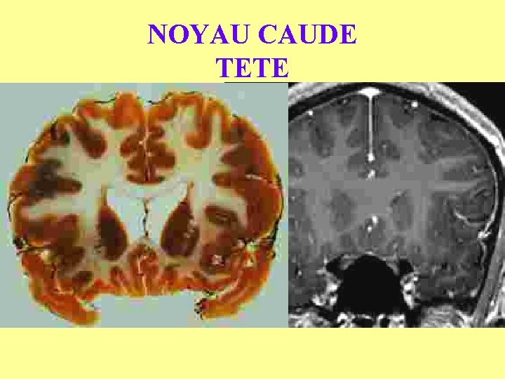 NOYAU CAUDE TETE 