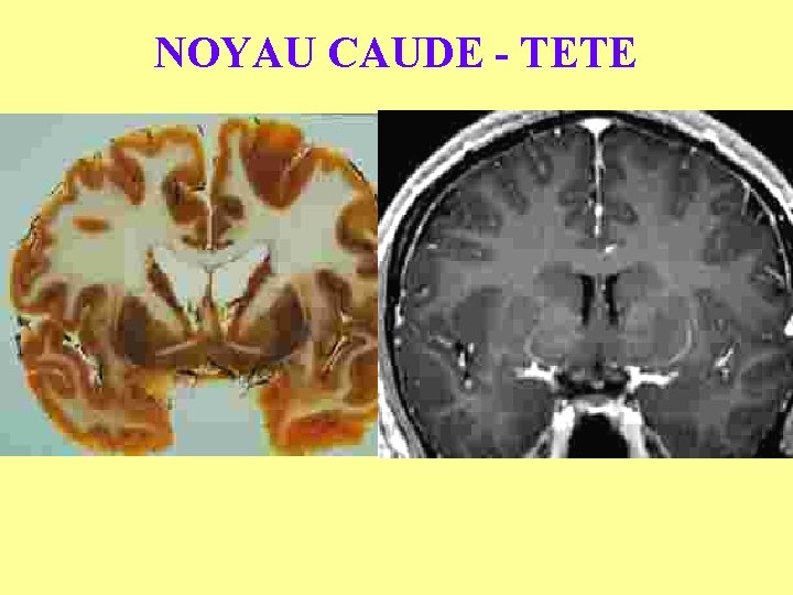 NOYAU CAUDE - TETE 