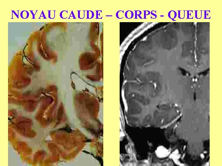 NOYAU CAUDE – CORPS - QUEUE 