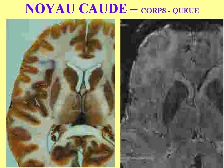 NOYAU CAUDE – CORPS - QUEUE 