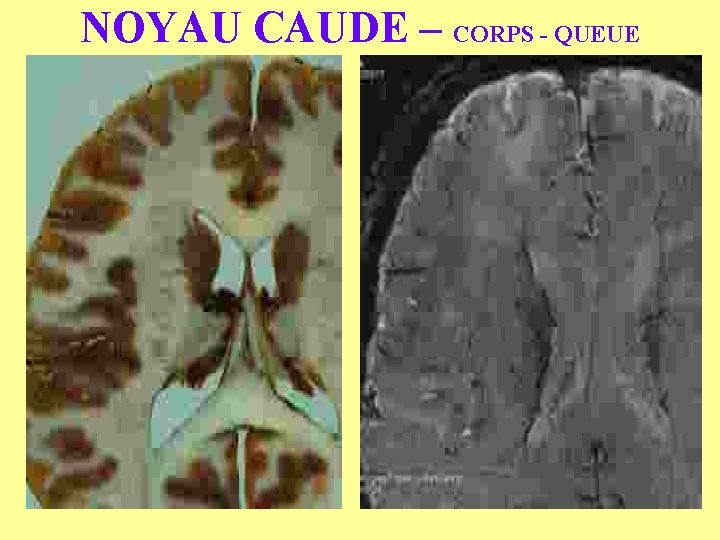 NOYAU CAUDE – CORPS - QUEUE 