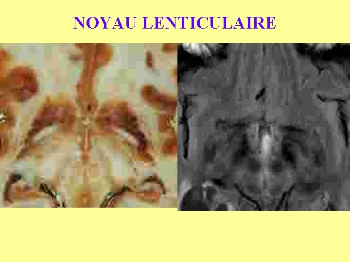 NOYAU LENTICULAIRE 