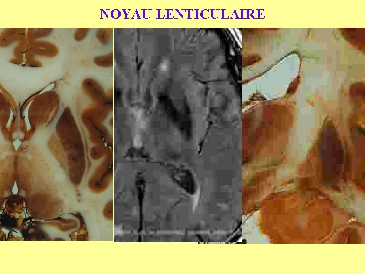 NOYAU LENTICULAIRE 