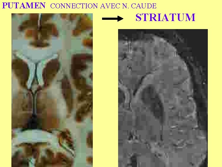 PUTAMEN CONNECTION AVEC N. CAUDE STRIATUM 