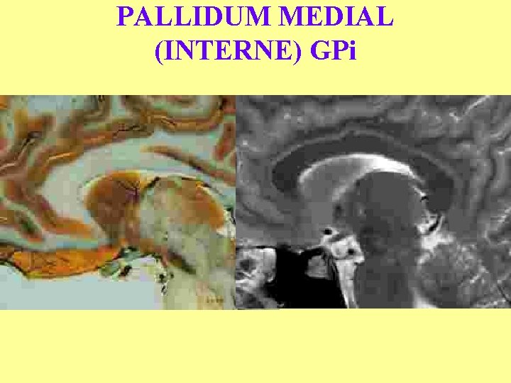 PALLIDUM MEDIAL (INTERNE) GPi 