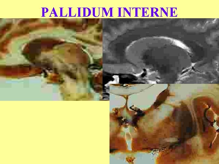 PALLIDUM INTERNE 