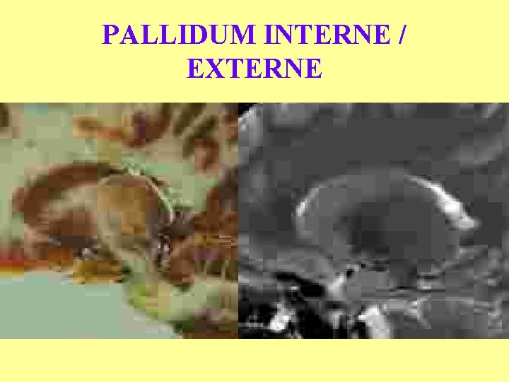 PALLIDUM INTERNE / EXTERNE 