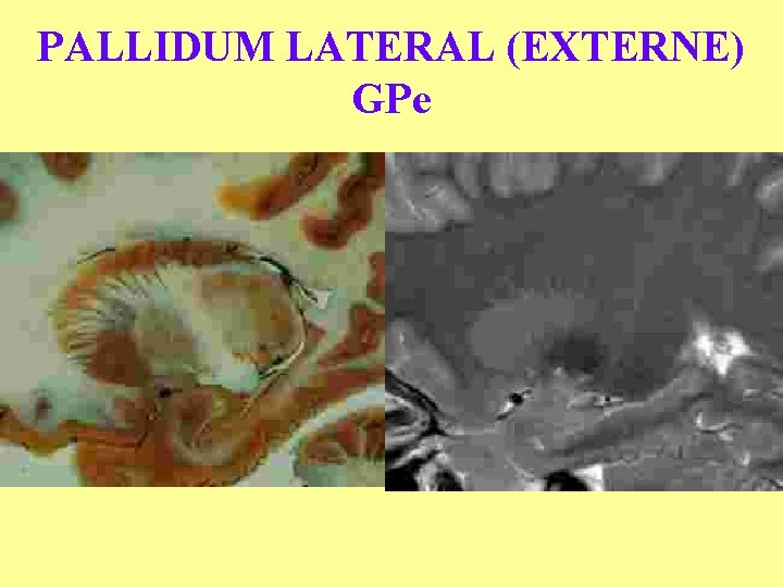 PALLIDUM LATERAL (EXTERNE) GPe 