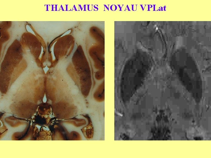 THALAMUS NOYAU VPLat 