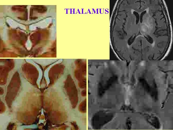 THALAMUS 