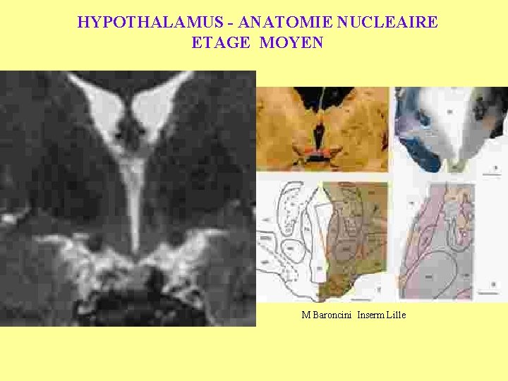 HYPOTHALAMUS - ANATOMIE NUCLEAIRE ETAGE MOYEN M Baroncini Inserm Lille 