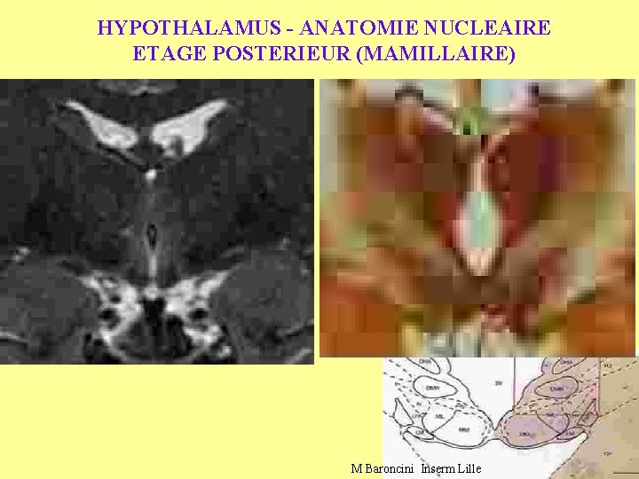 HYPOTHALAMUS - ANATOMIE NUCLEAIRE ETAGE POSTERIEUR (MAMILLAIRE) M Baroncini Inserm Lille 