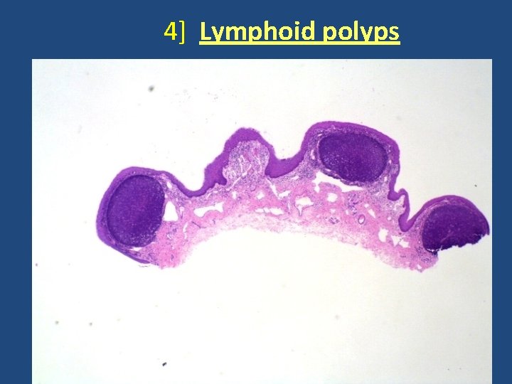 4] Lymphoid polyps 