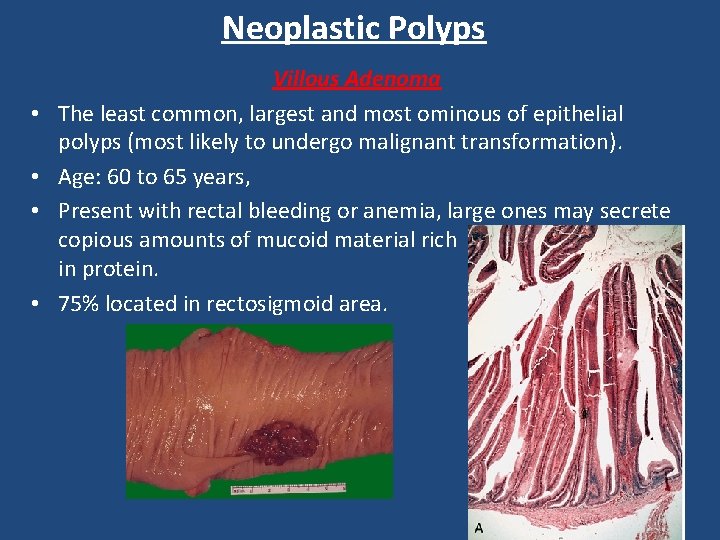 Neoplastic Polyps • • Villous Adenoma The least common, largest and most ominous of