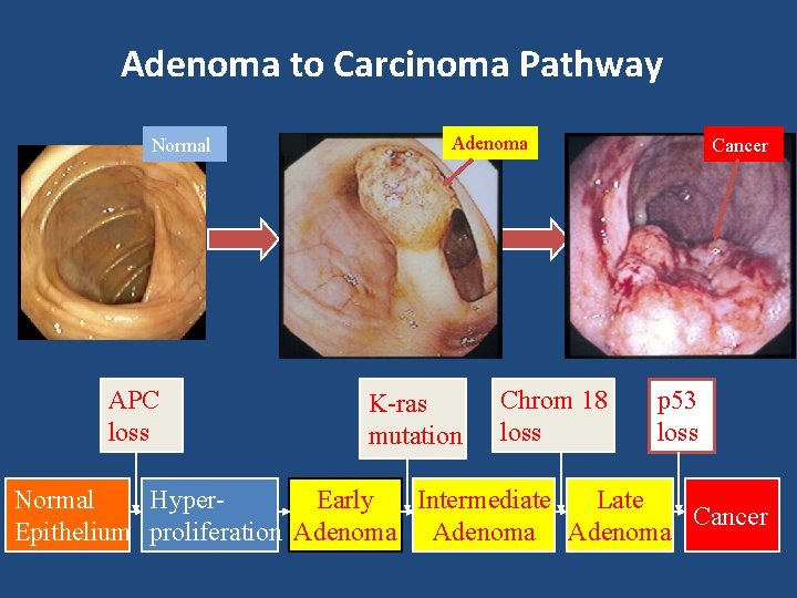 Adenoma to Carcinoma Pathway Normal APC loss Adenoma K-ras mutation Chrom 18 loss Cancer