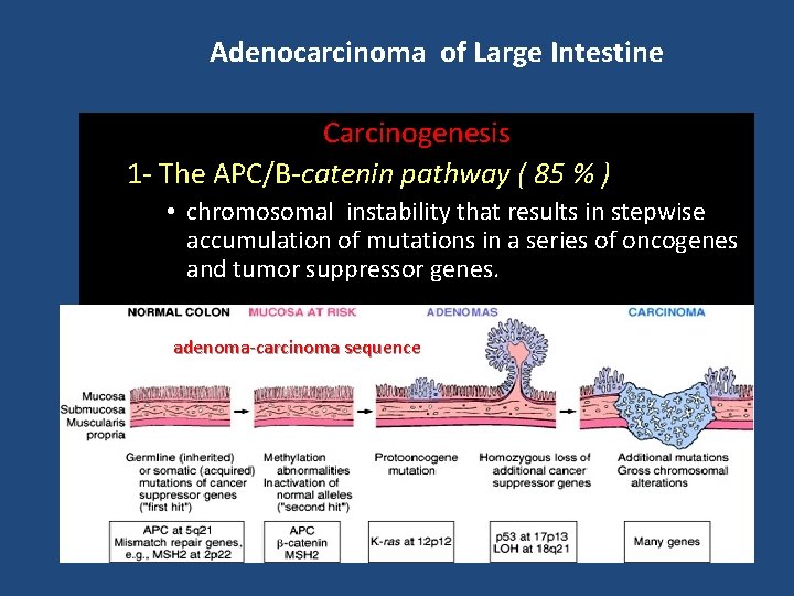 Adenocarcinoma of Large Intestine Carcinogenesis 1 - The APC/B-catenin pathway ( 85 % )