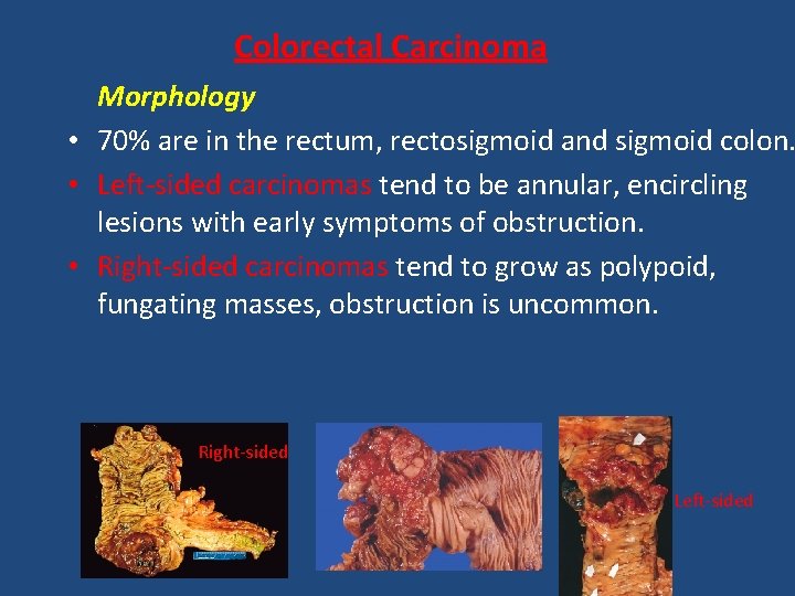Colorectal Carcinoma Morphology • 70% are in the rectum, rectosigmoid and sigmoid colon. •
