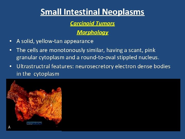 Small Intestinal Neoplasms Carcinoid Tumors Morphology • A solid, yellow-tan appearance • The cells