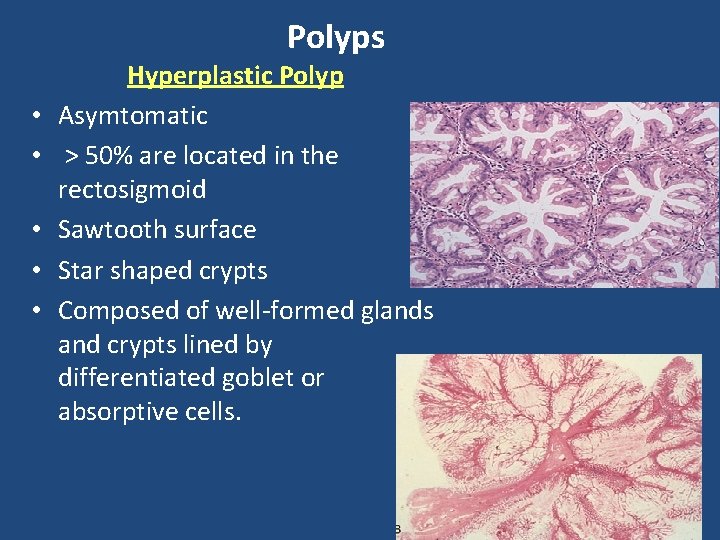 Polyps • • • Hyperplastic Polyp Asymtomatic > 50% are located in the rectosigmoid