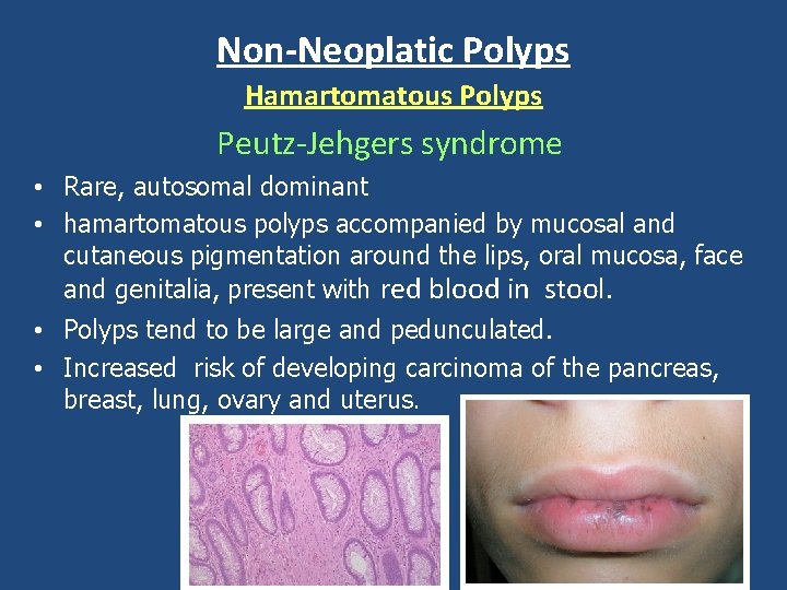 Non-Neoplatic Polyps Hamartomatous Polyps Peutz-Jehgers syndrome • Rare, autosomal dominant • hamartomatous polyps accompanied
