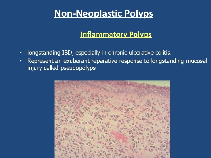Non-Neoplastic Polyps Inflammatory Polyps • longstanding IBD, especially in chronic ulcerative colitis. • Represent